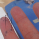 Wilcox’s finger with venomous sea urchin spines. (Image: Christie Wilcox)